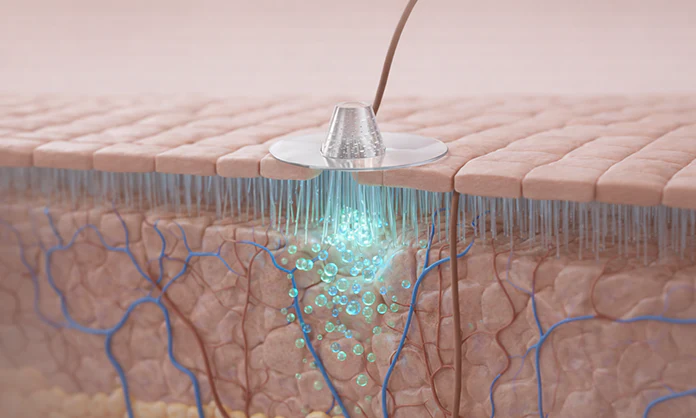 Painless delivery beneath the skin surface